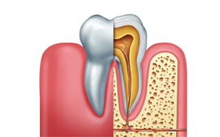 root-canal-dentist-11230