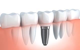 dental-implants-dentist-Brooklyn