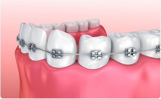 Orthodontist in 11204, Braces 11204